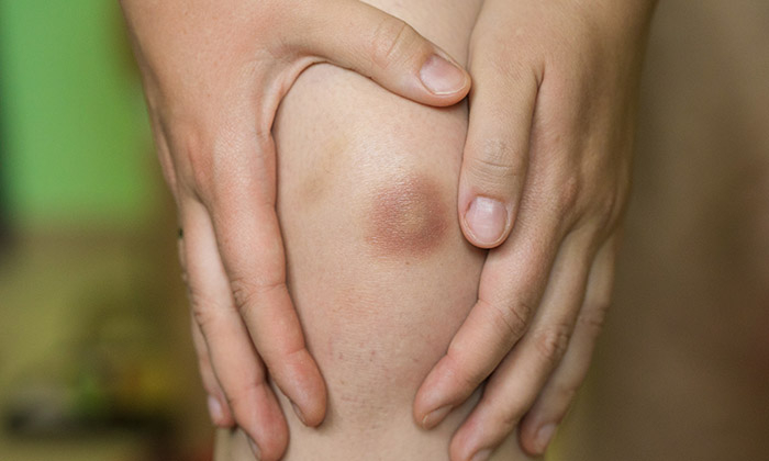 9 สาเหตุของอาการ รอยช้ำ ที่ควรรู้