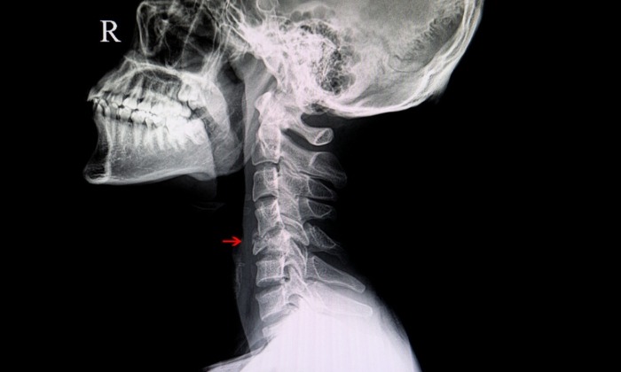 กระดูกคอหัก (Cervical fracture)