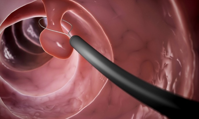 ติ่งเนื้อในลำไส้ใหญ่ (colon polyp)