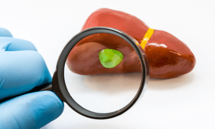 มะเร็งถุงน้ำดี อาการ สาเหตุ วิธีรักษา