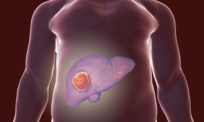 เนื้องอกตับ อาการ สาเหตุ และการรักษา