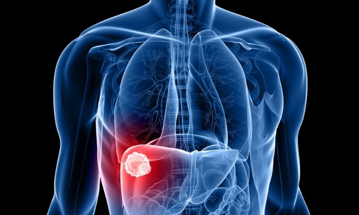 มะเร็งตับ (Liver cancer)