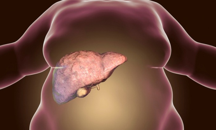 ไขมันพอกตับที่ไม่ได้เกิดจากแอลกอฮอล์ (Nonalcoholic fatty liver)