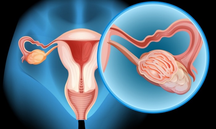 มะเร็งรังไข่ (Ovarian Cancer)