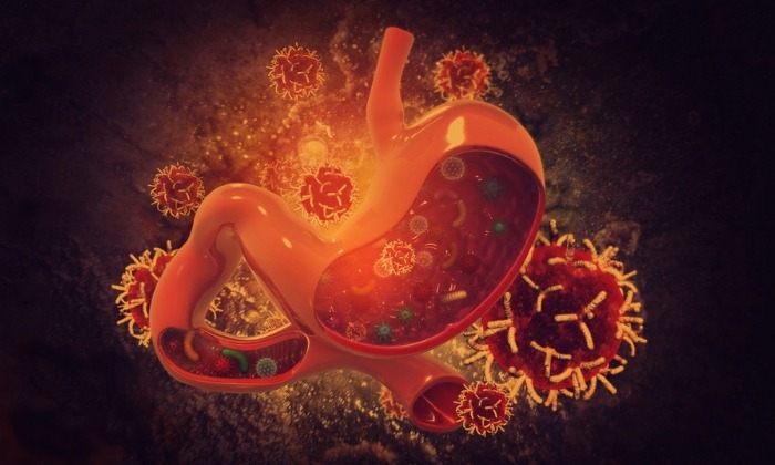 มะเร็งกระเพาะอาหาร (Stomach cancer)