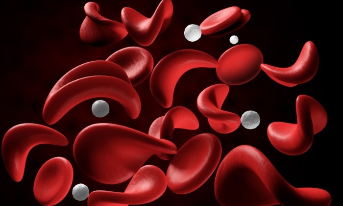 โลหิตจางอย่างร้าย (Pernicious Anemia) คืออะไร