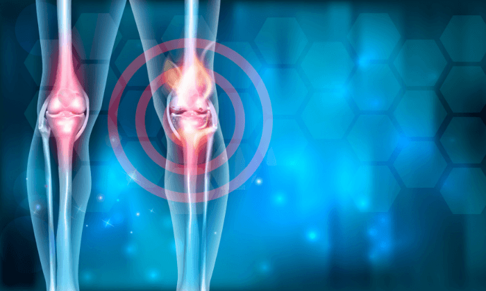 ข้ออักเสบ (Arthritis)