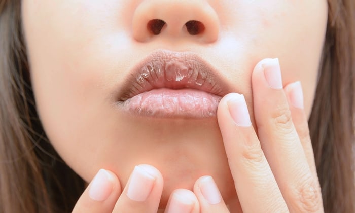 ริมฝีปากลอก สาเหตุ การบรรเทาอาการ และการป้องกัน