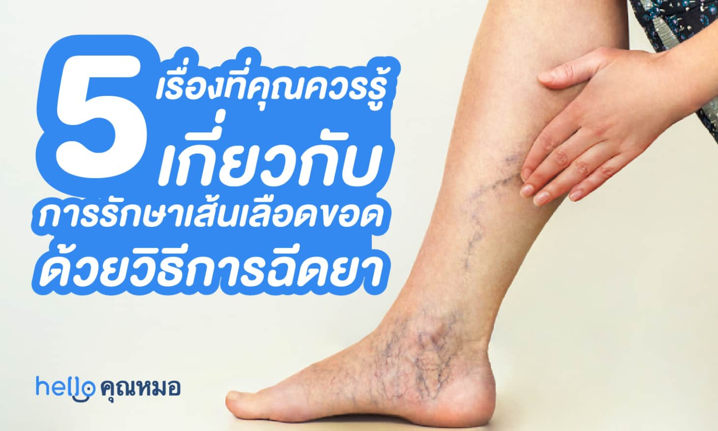 5 เรื่องที่คุณควรรู้เกี่ยวกับ การรักษาเส้นเลือดขอด ด้วยวิธีการฉีดยา