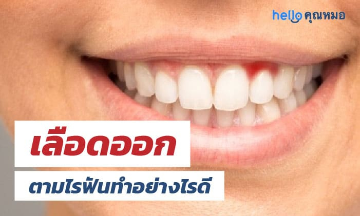 อาการเลือดออกตามไรฟัน รับมือกับอาการอย่างไรดี