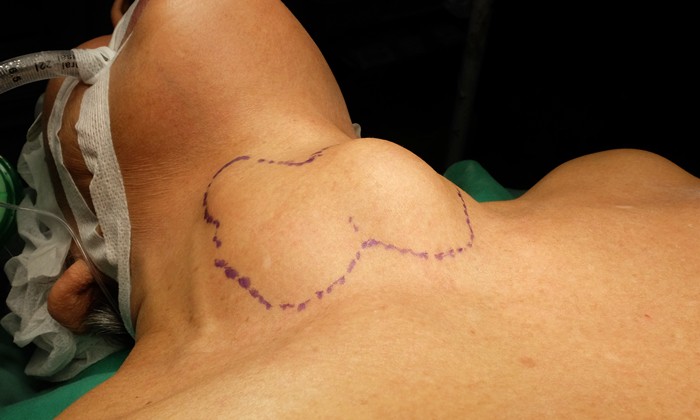 ผ่าตัดต่อมไทรอยด์ออกเกือบหมด (Subtotal Thyroidectomy)