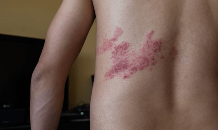 งูสวัด (Shingles)