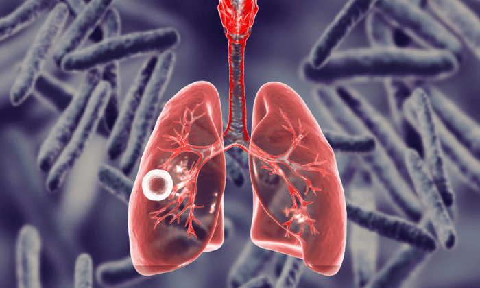 วัณโรค (Tuberculosis)
