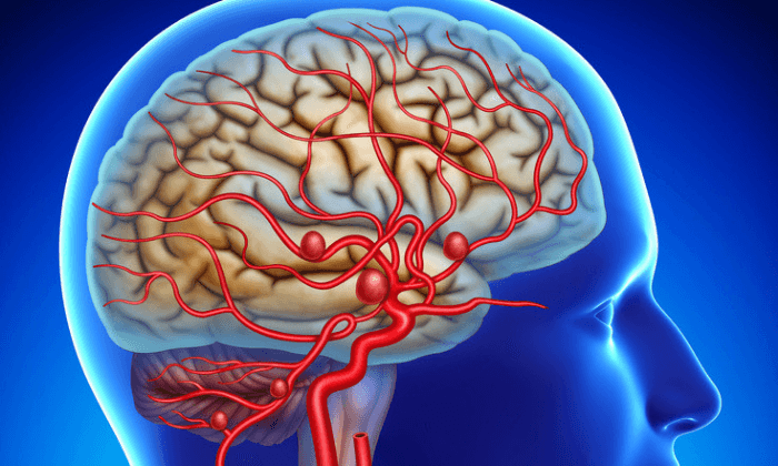 ภาวะหลอดเลือดแข็ง หนึ่งในสาเหตุที่พบบ่อยของโรคหลอดเลือดสมอง