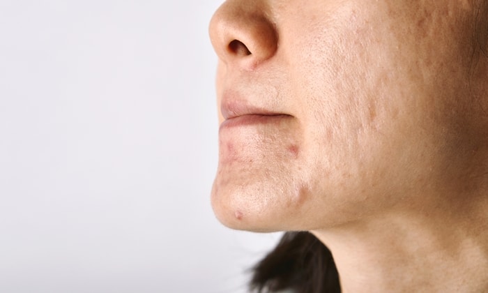 สภาพอากาศและมลภาวะ ส่งผลต่อการเกิดสิวอย่างไร