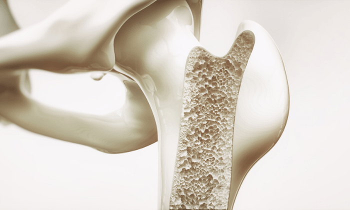 กระดูกพรุน (Osteoporosis)