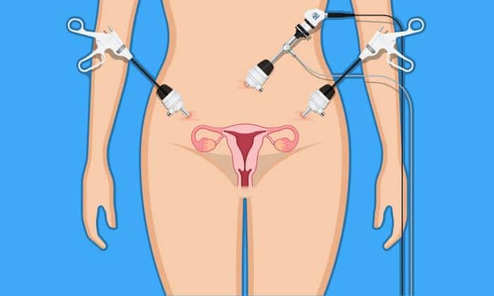 ผ่าตัดมดลูกผ่านทางช่องคลอด (Vaginal Hysterectomy)