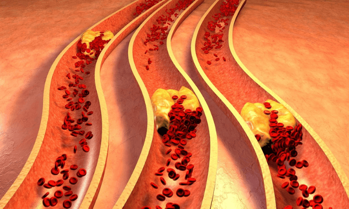 คอเลสเตอรอลสูง (High cholesterol)