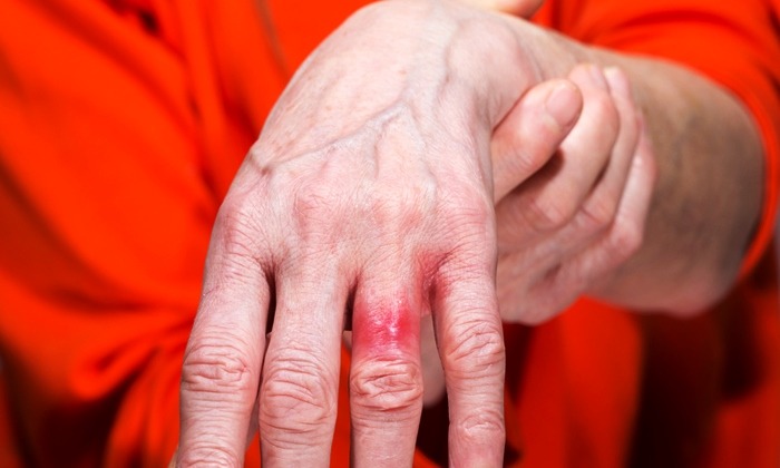 ภูมิแพ้นิกเกิล โรคที่คนชอบใส่เครื่องประดับต้องระวัง