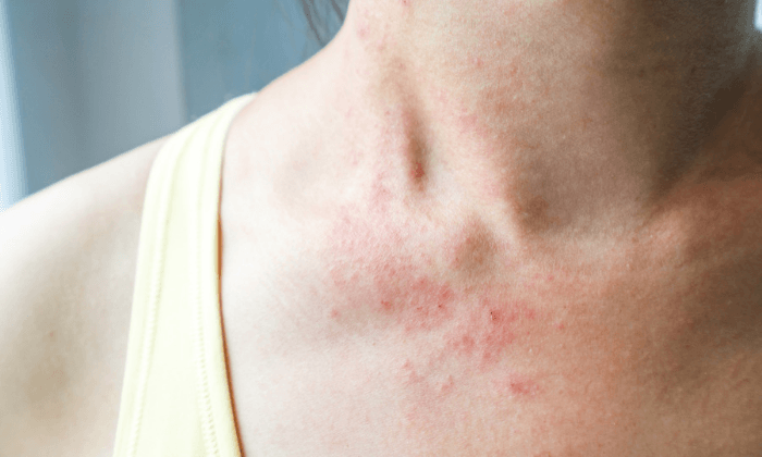 ผื่นผิวหนัง (Skin Rash) อาการ สาเหตุ วิธีรักษาและป้องกัน