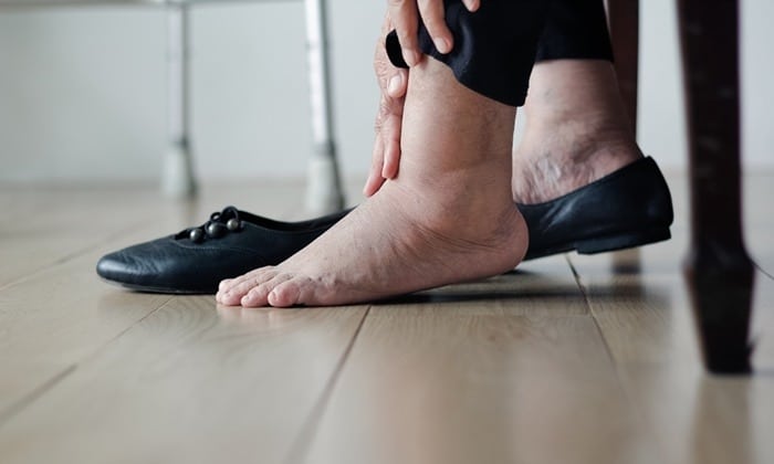 ภาวะ แทรกซ้อน เบาหวาน อาการขาและเท้าบวม