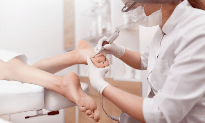 รักษาตาปลา และหนังหนา ด้วย 6 วิธีที่นิยมใช้