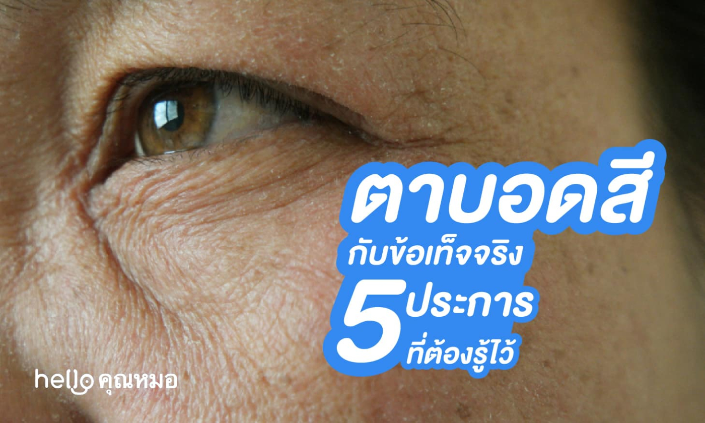 อาการตาบอดสี กับข้อเท็จจริง 5 ประการที่ควรต้องรู้ไว้