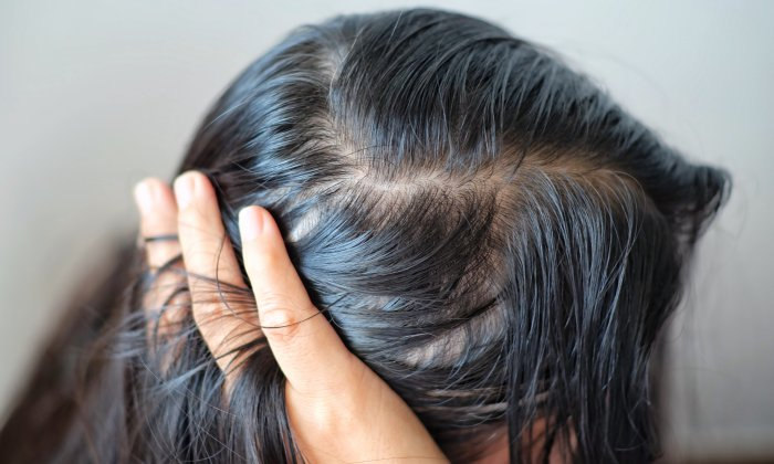 เซ็บเดิร์ม อาการ สาเหตุ การรักษา