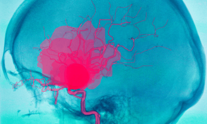 เลือดคั่งในสมอง (Intracerebral Hemorrhage: ICH)