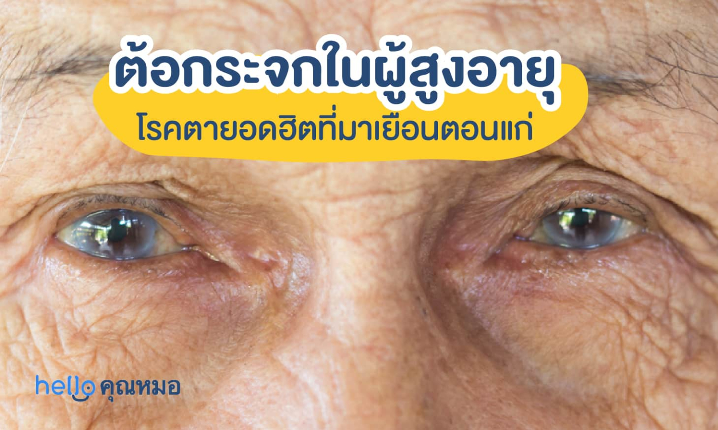 ต้อกระจกในผู้สูงอายุ โรคตายอดฮิตที่มาเยือนยามแก่