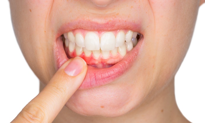 บอกลาเหงือกอักเสบด้วย วิธีเยียวยาเหงือกอักเสบ ง่ายๆ ที่คุณก็ทำได้