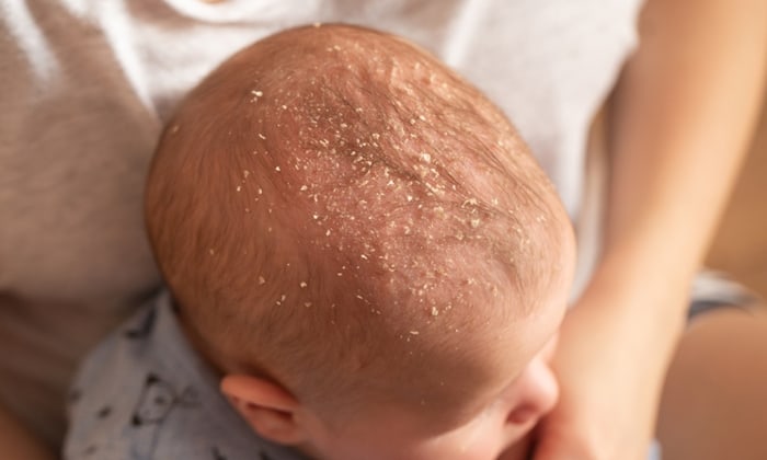 ทารกหนังศีรษะแห้ง เป็นสะเก็ด ควรรักษาอย่างไรเพื่อให้อาการดีขึ้น