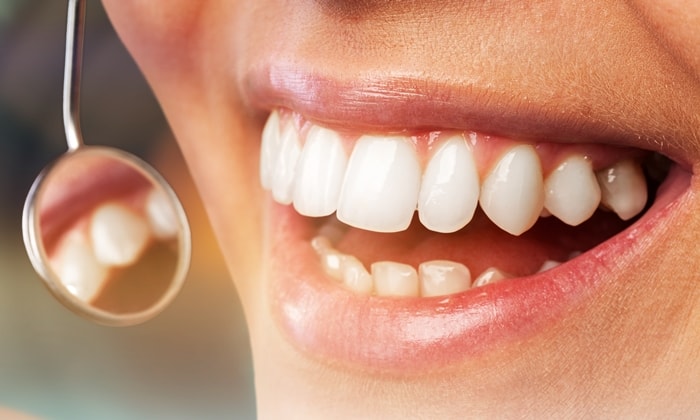 ปริทันต์อักเสบ (Periodontitis)