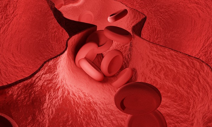 หลอดเลือดแดงอักเสบทากายาสุ (Takayasu's Arteritis)