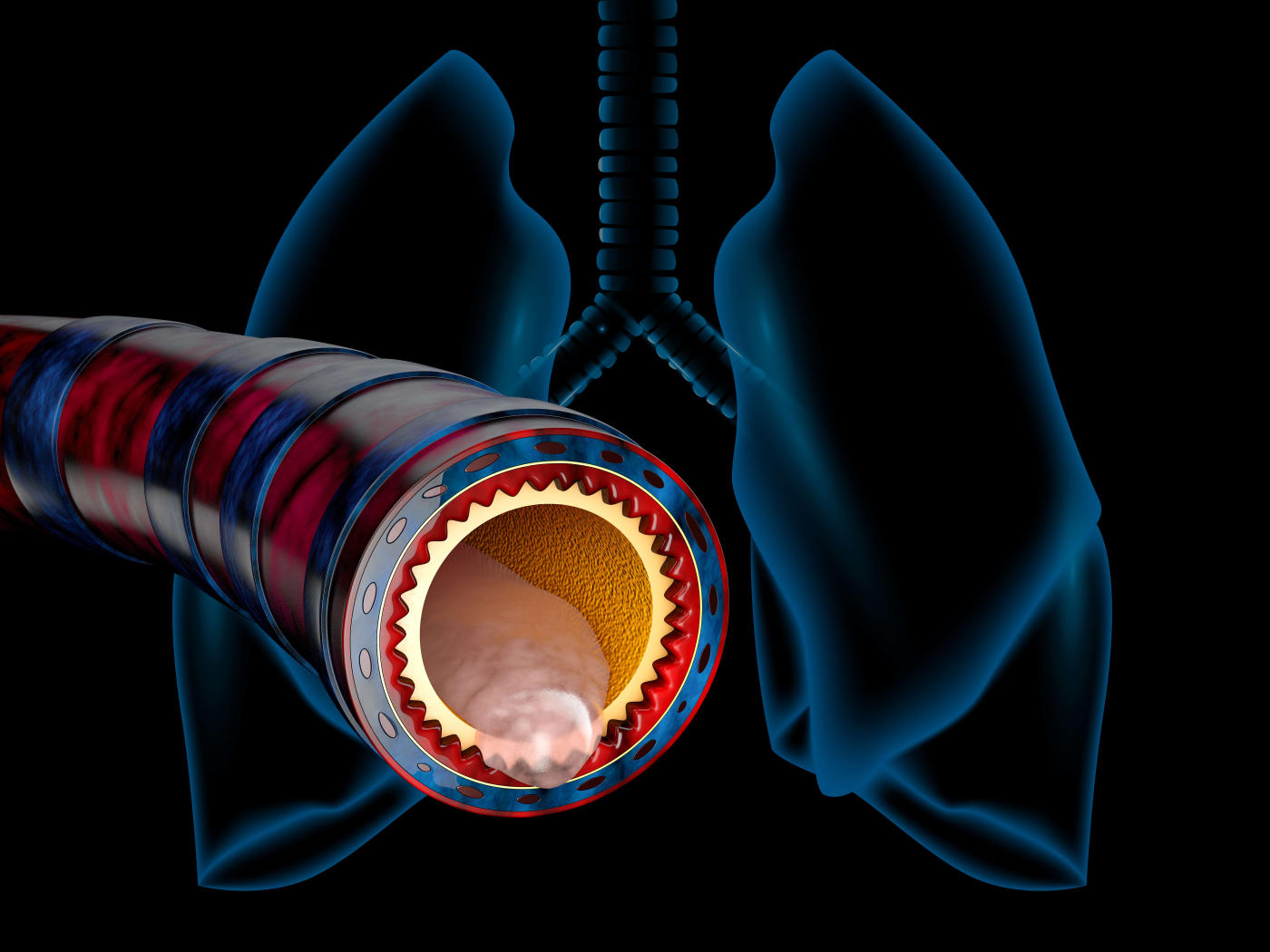 หลอดลมอักเสบเฉียบพลัน (Acute bronchitis)
