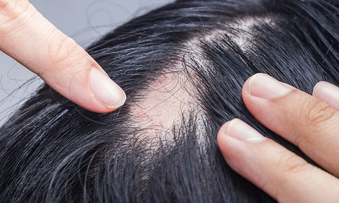 มลพิษทางอากาศ สาเหตุของผมร่วง ศีรษะล้าน