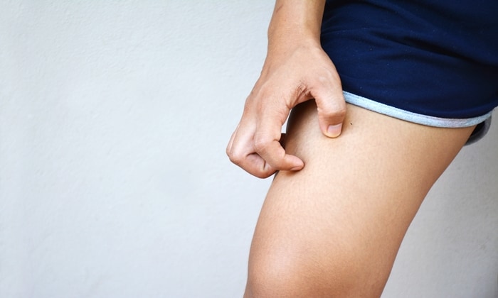 วิธีแก้ขาหนีบดำ อย่างเป็นธรรมชาติ และวิธีป้องกันขาหนีบดำ