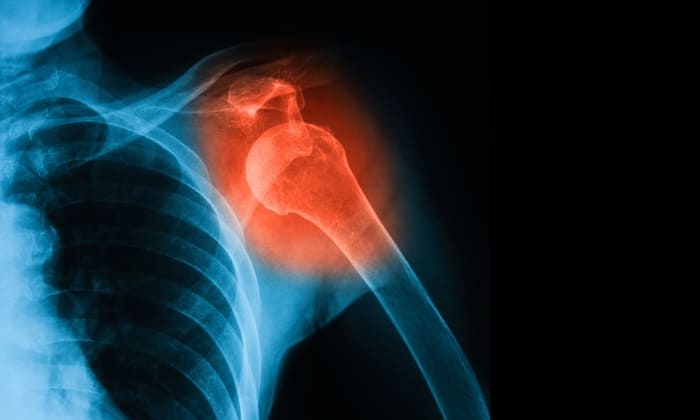 ข้อเคลื่อน (Dislocation)