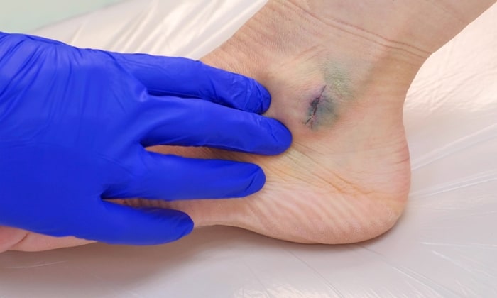 ลิ่มเลือดอุดตัน เลือดคั่งหลังผ่าตัด ผลข้างเคียงจากการศัลยกรรมที่ป้องกันได้