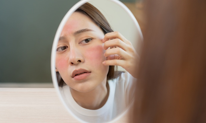 สิว อาการ สาเหตุ และการรักษา