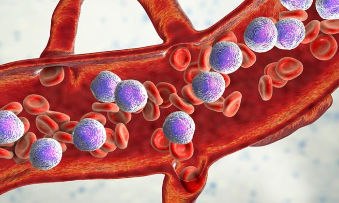 มะเร็งเม็ดเลือดขาวกลุ่มลิมโฟซิติค (Acute Lymphocytic Leukemia)