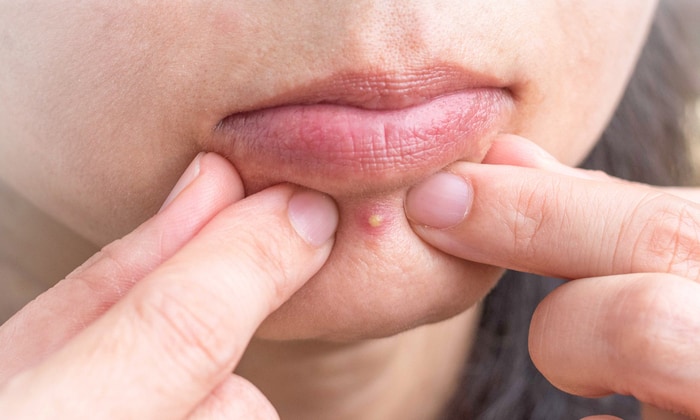 สิวที่คาง สาเหตุ การรักษา และการป้องกัน