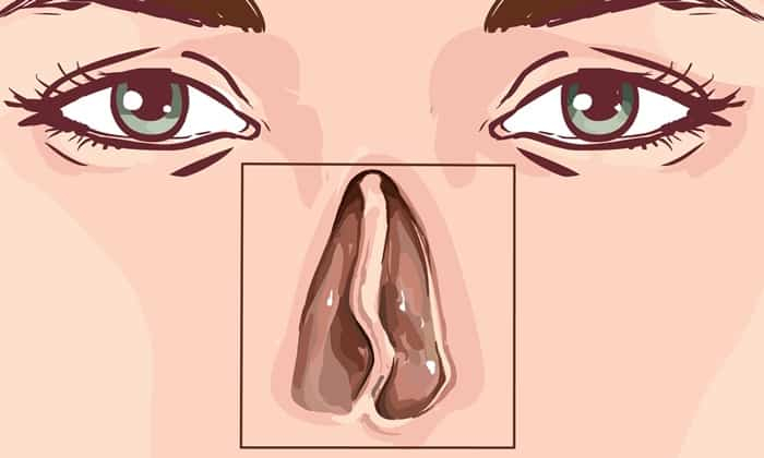 หายใจไม่สะดวก คัดจมูกบ่อยๆ อาจมีสาเหตุมาจาก ผนังกั้นช่องจมูกคด