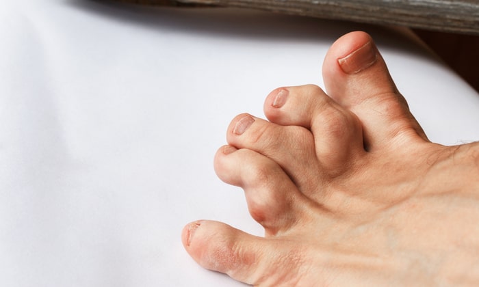 เมื่อร่างกายเกิดผิดรูป เสี่ยงเป็น โรคเอฟโอพี (FOP) หรือไม่ ?