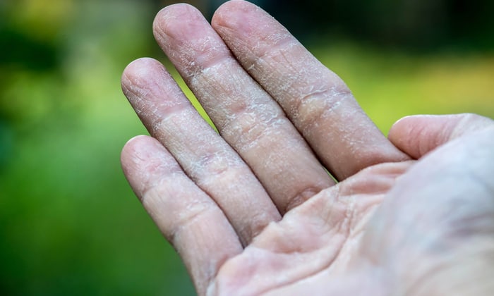 มือลอก สัญญาณสะท้อนปัญหาสุขภาพด้านใดบ้าง