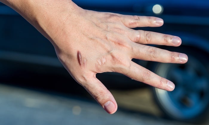 แผลเป็นนูน หรือคีลอยด์ สาเหตุ และการรักษาที่เหมาะสม