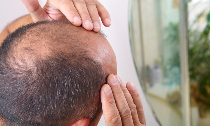 ผู้ชายหัวล้าน เกิดจากอะไร และวิธีการรักษา