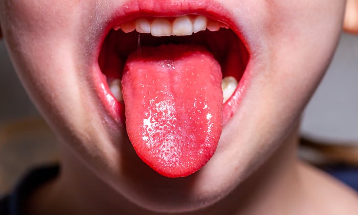 ลิ้นส้ม แบบนี้ เป็นสัญญาณอันตรายของสุขภาพหรือเปล่า