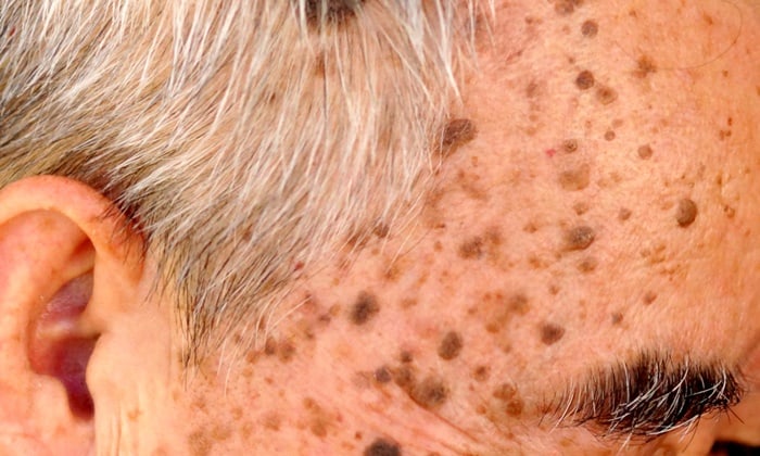 กระเนื้อ สัญญาณมะเร็งผิวหนังจริงหรือ