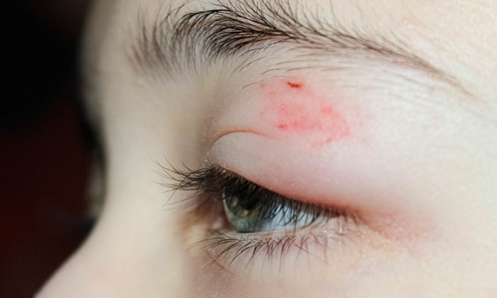 เปลือกตาบวม (Swollen Eyelid) เรื่องเล็กๆ ที่ไม่ควรมองข้าม